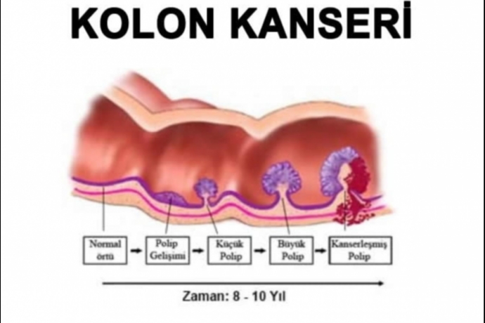 Kolon Kanseri Tehlikesi G�z A�t�rm�yor: Erken Te�his Hayat Kurtar�yor